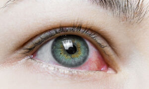 Dry, irritated, red eyes? This one is for you.